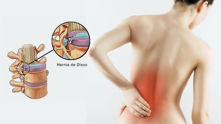 hernia-discal