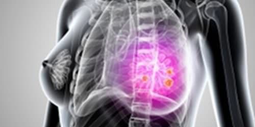 quiropractica cancer mama