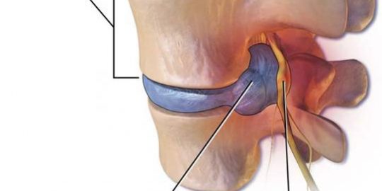 Hernia discal Cervical (1) Hernia discal Cervical