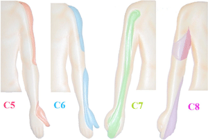 La hernia cervical y el tratamiento quiropráctico